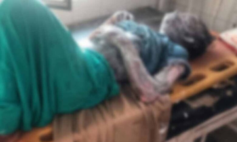 अमरोहा में हुए तेजाब हमले में झुलसी छात्रा ने उपचार के दाैरान तोड़ा दम 1 KSHITITECH tejab1 KSHITITECH