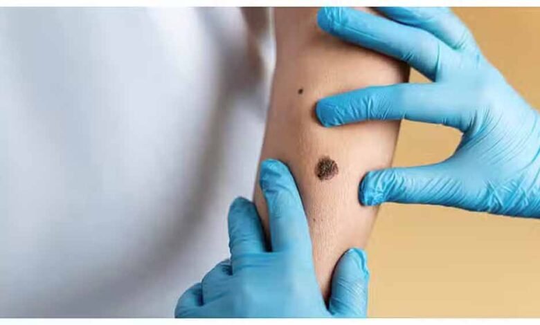 जिस संक्रामक रोग के कारण दो बार घोषित हुआ 'आपातकाल', कई देशों में फिर बढ़ने लगे उसके मामले 1 KSHITITECH monky1 KSHITITECH