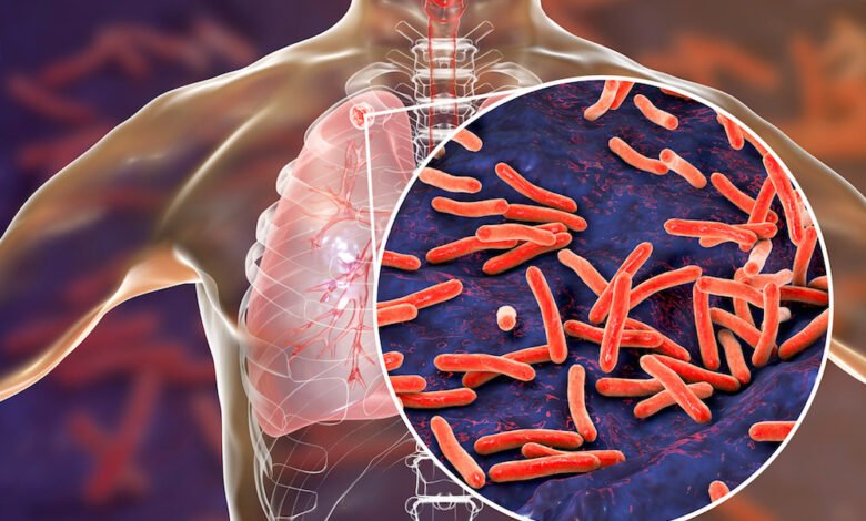मध्य प्रदेश के 19 जिलों में तेजी से बढ़े TB मरीज, केंद्र सरकार के आंकड़ों ने डराया 1 KSHITITECH 18A 97 KSHITITECH